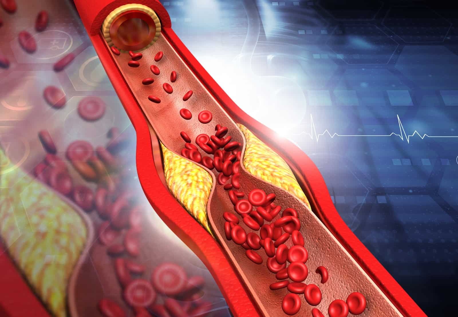 clogged-arteries-cholesterol-plaque-in-artery-3d-illustration