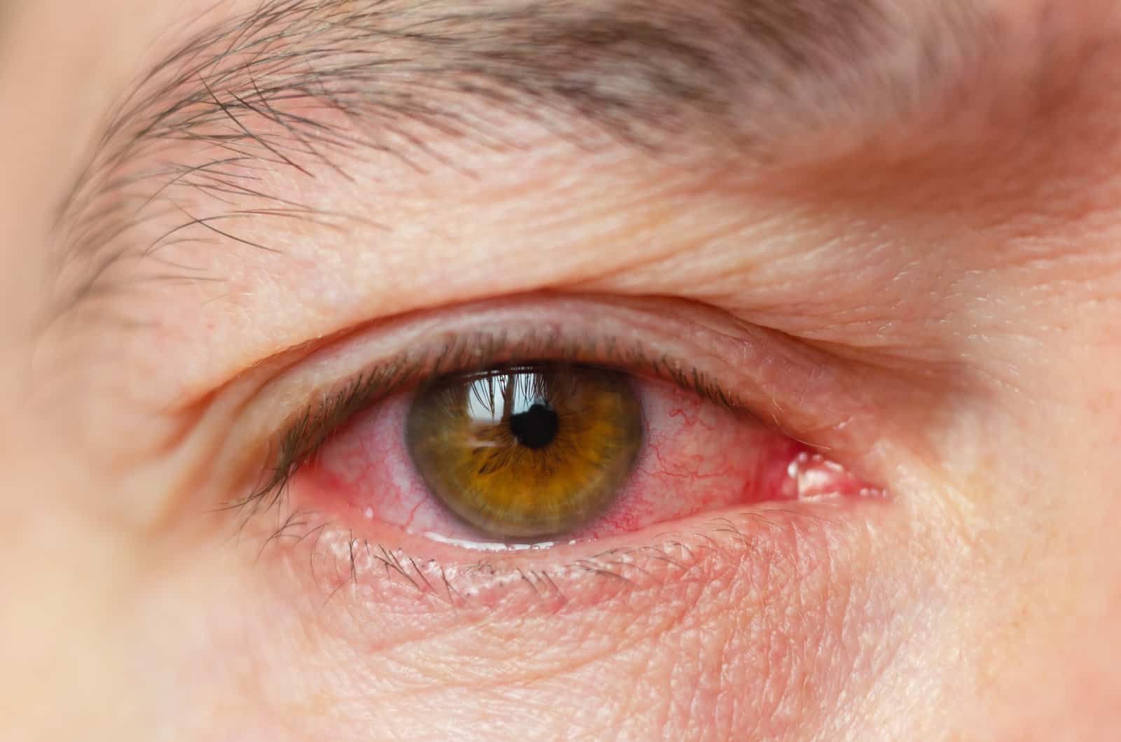 closeup-irritated-infected-red-bloodshot-eyes-conjunctivitis