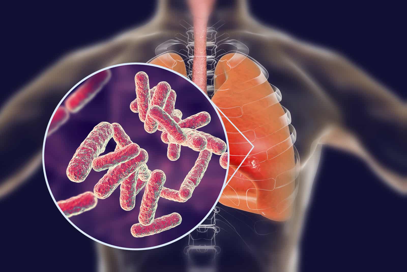 bacteria-pneumonia-medical-concept-3d-illustration-showing-human-lungs-and-close-up-view-of-rod-shaped-bacteria-in-lungs