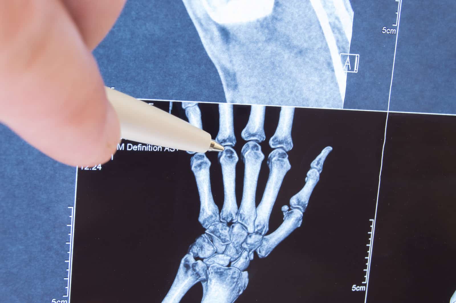 x-ray-scan-of-hand-bones-and-finger-joints-doctor-pointed-on-finger-small-joints-where-pathology-is-detected-such-as-arthritis-rheumatoidfracture-diagnosis-of-joint-diseases-by-radiology