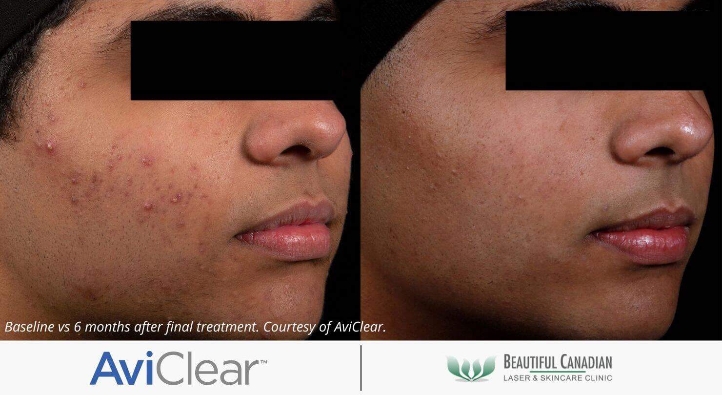 Accutane Cost Bc