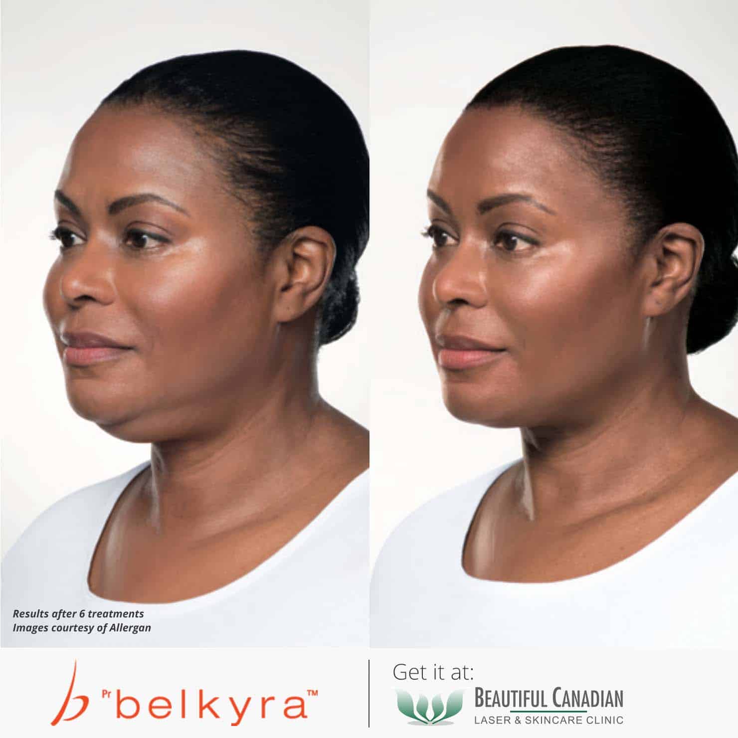 Belkyra before and after - female angle view - Ponti