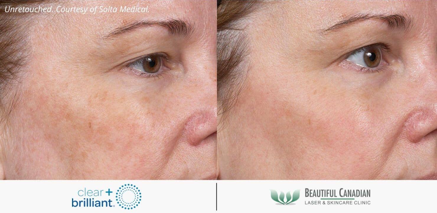 Clear Brilliant® Laser Skin Rejuvenation Vancouver Surrey