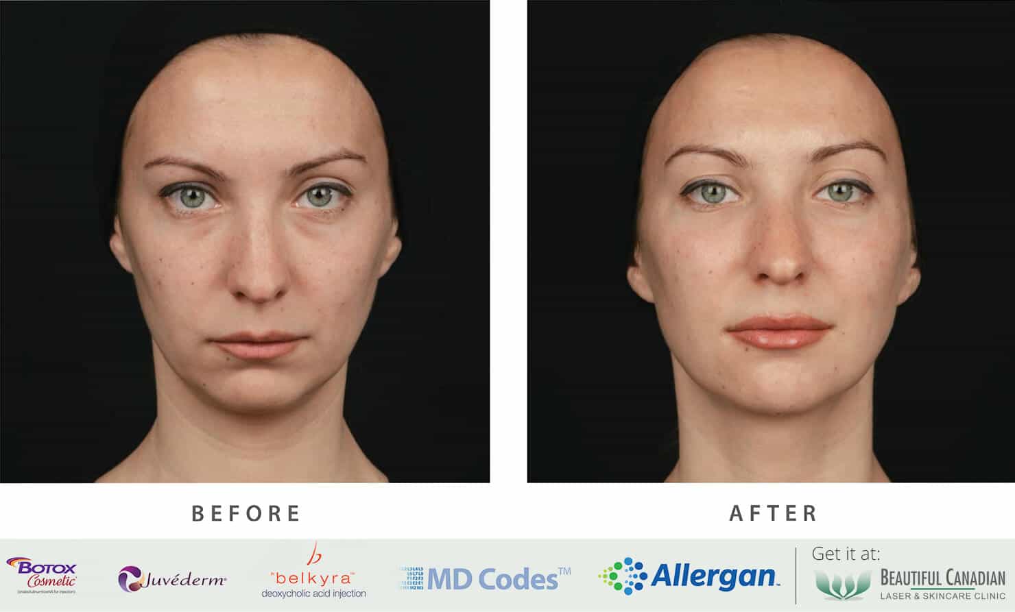 Vancouver NonSurgical Facelift w/ Botox® & Fillers Surrey Softlift