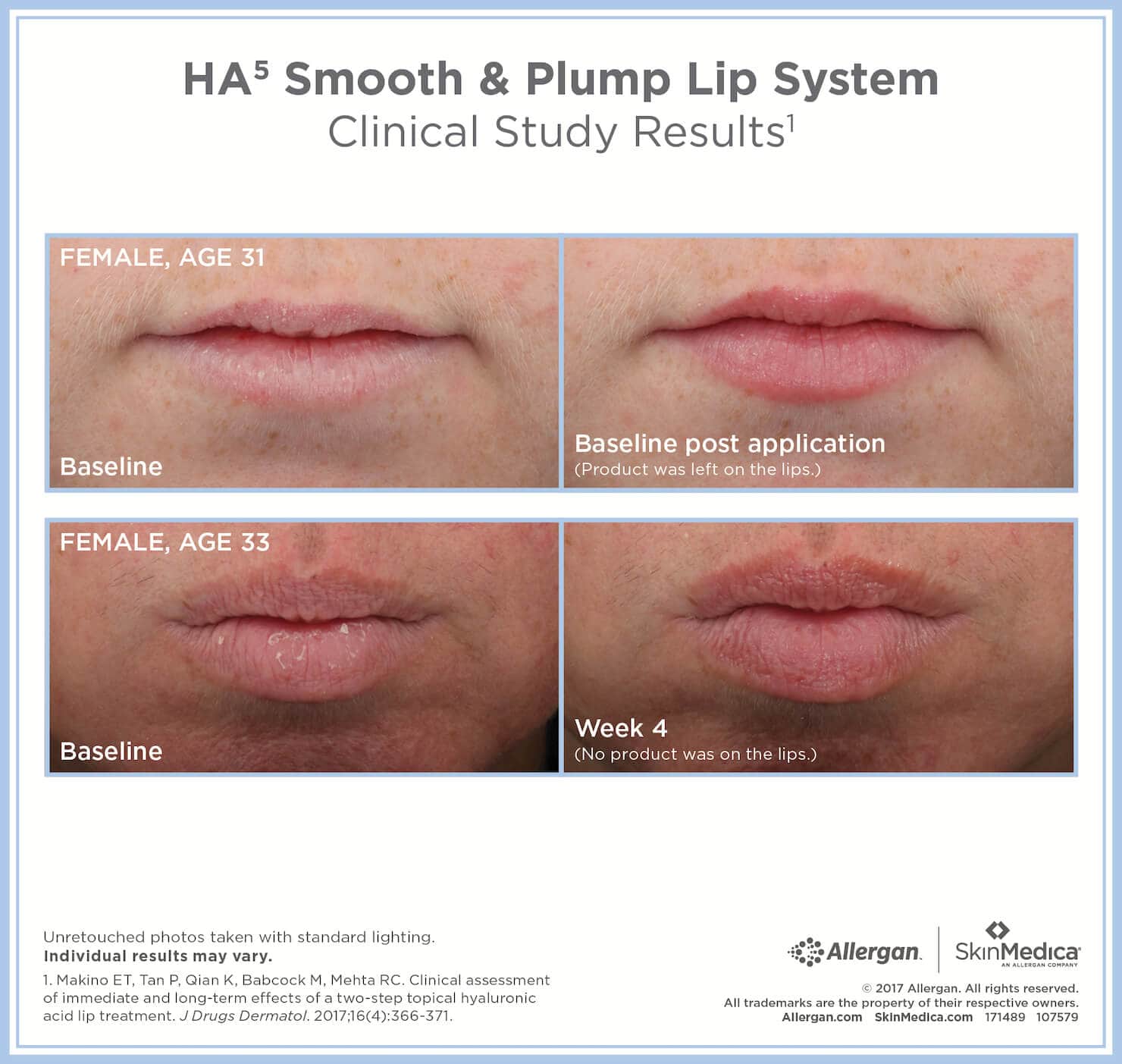 SkinMedica Before and After photo of HA5 Smooth & Plump Lip System - high end skincare results from clinical study