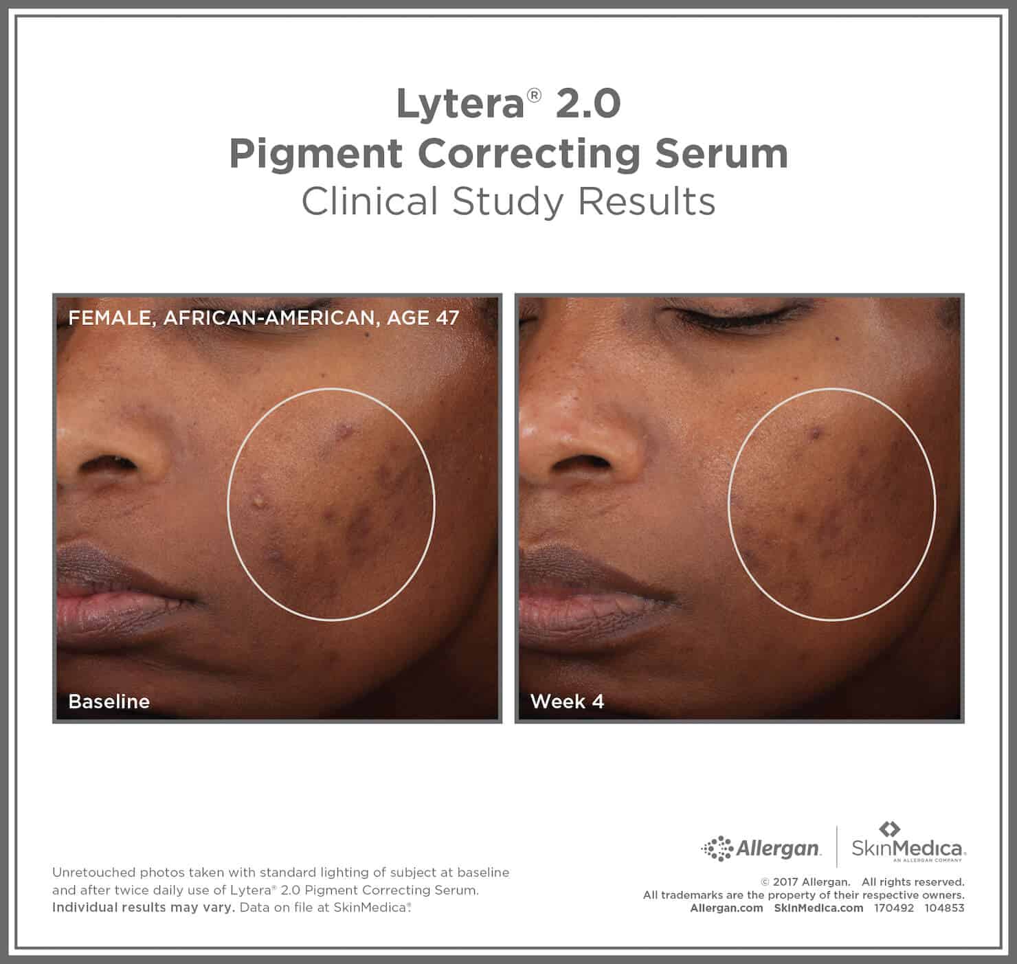 SkinMedica Before and After photo of Lytera 2.0 Pigment Correcting Serum - high end skincare results from clinical study