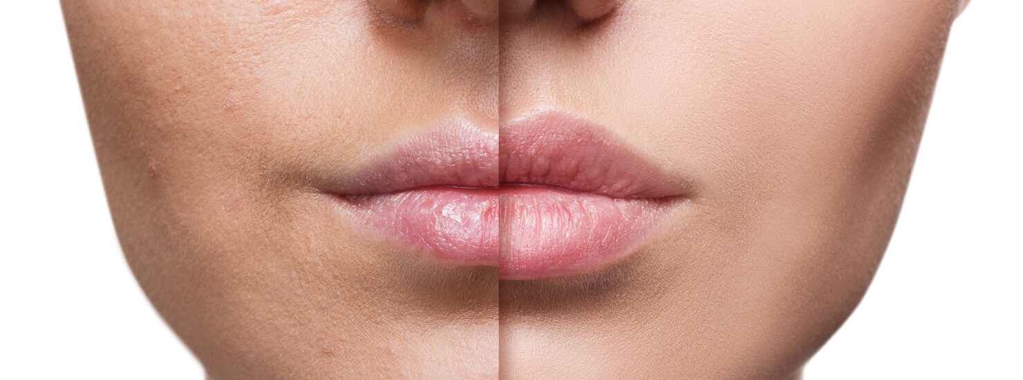 thin lips before and after lip augmentation
