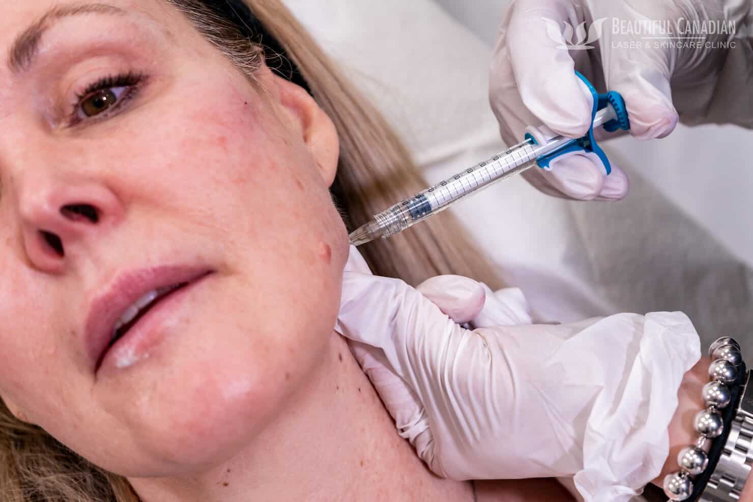 Vancouver jawline jowl contour treatment with dermal filler