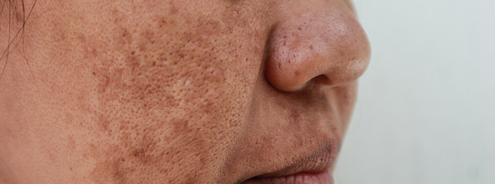 Led Red Light Therapy For Melasma Shelly Lighting