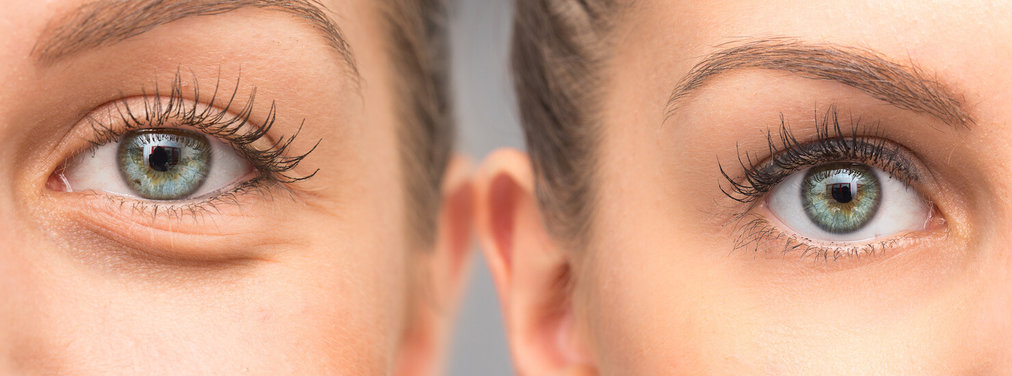 How to Conceal Under Eye Bags and Dark Circles