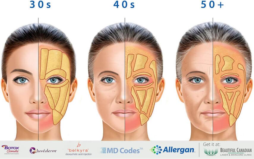 https://cdn.shortpixel.ai/spai5/q_lossy%2Bw_855%2Bto_webp%2Bret_img/www.bclaserandskincare.com/wp-content/uploads/fat-pads-diagram-logos-md-codes-allergan.jpg