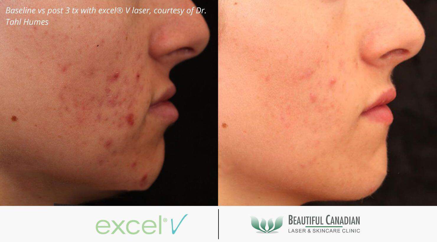 Acne laser treatment before and after with excel V - available in Vancouver Surrey