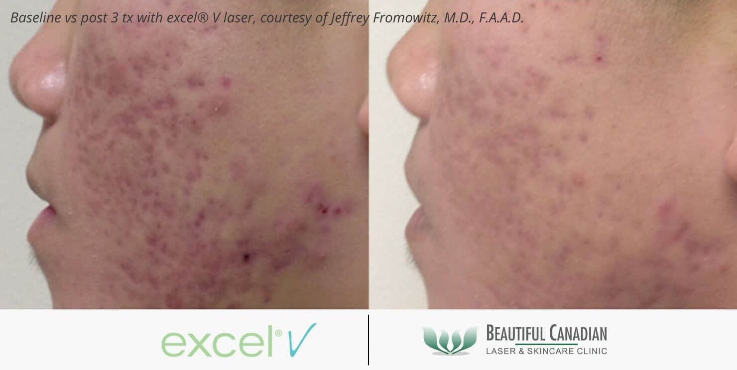 Acne redness treatment before and after with excel V laser - available in Vancouver Surrey