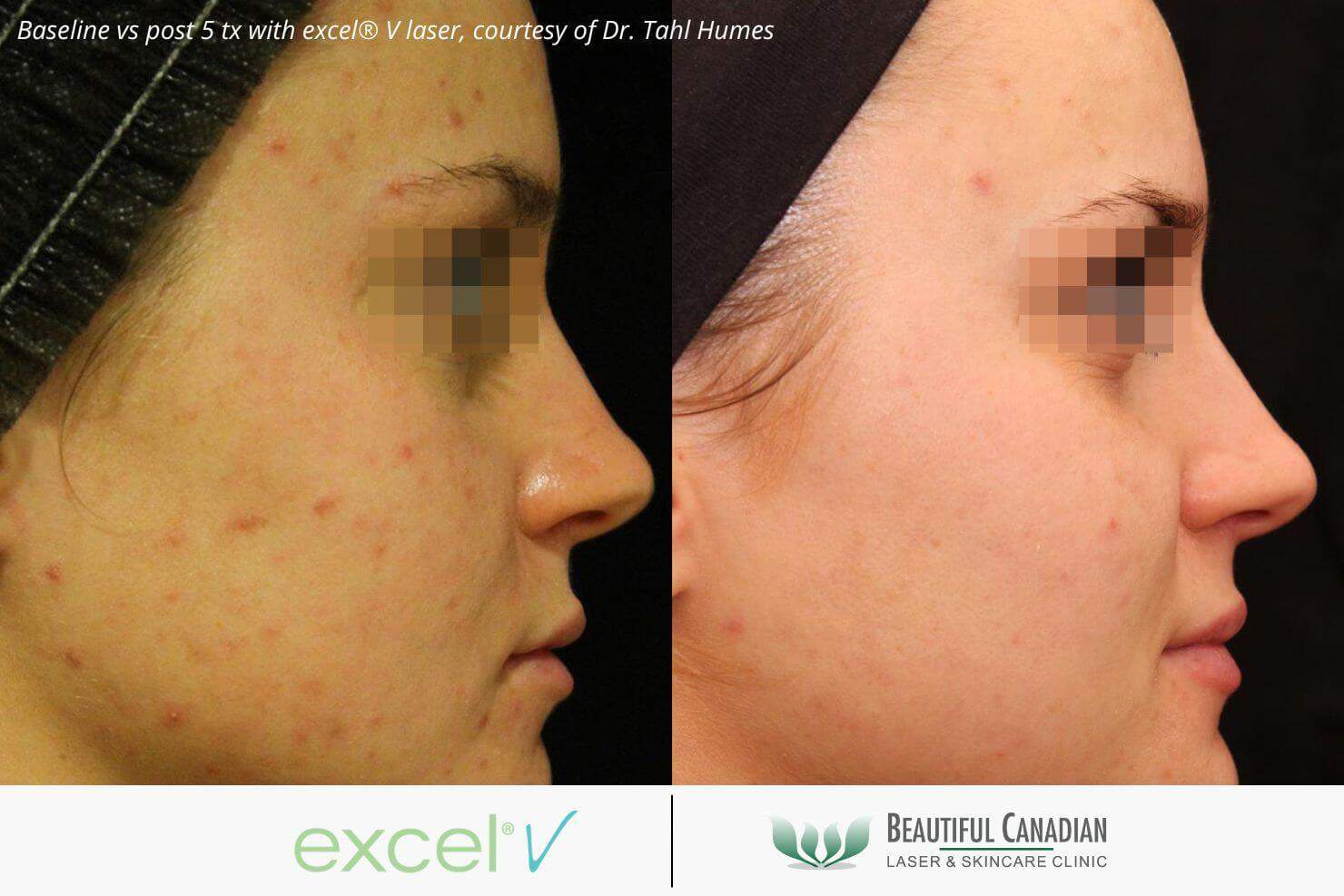 Acne before and after laser treatments with excel V laser - available in Vancouver Surrey