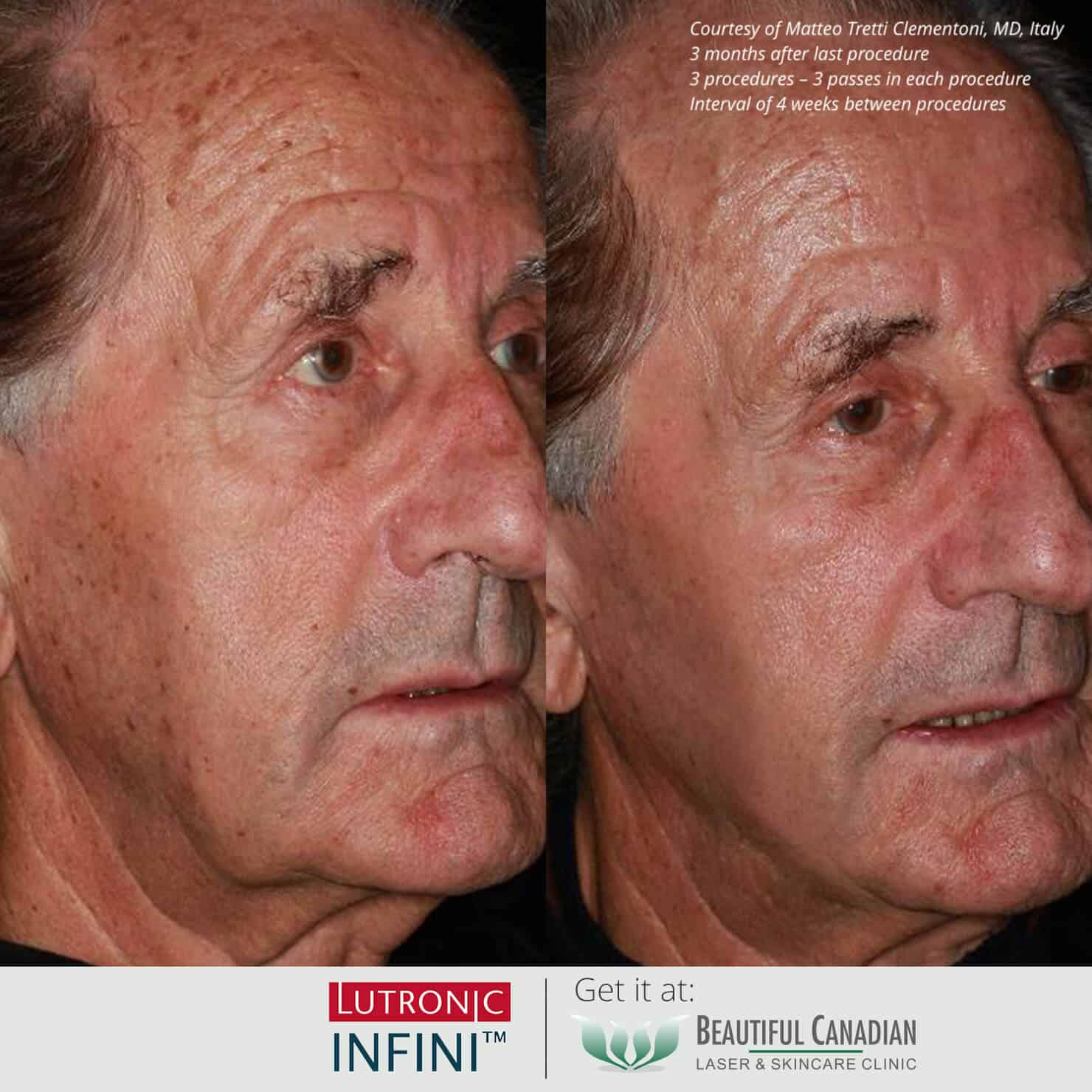 Before and after images of Infini RF hot microneedling procedure for skin laxity - available in Vancouver