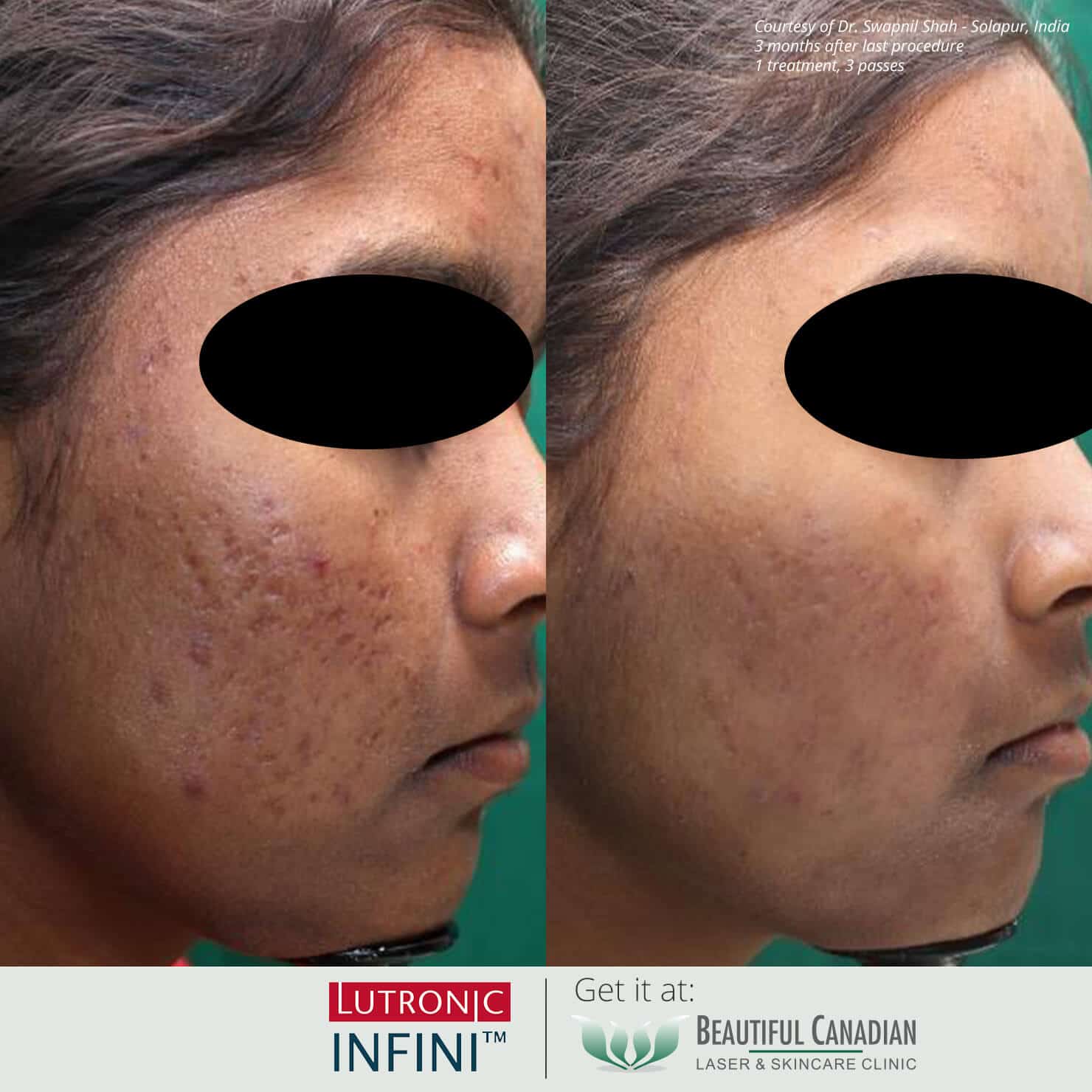 Before and after images of Infini RF microneedling procedure for acne scars - available in Vancouver