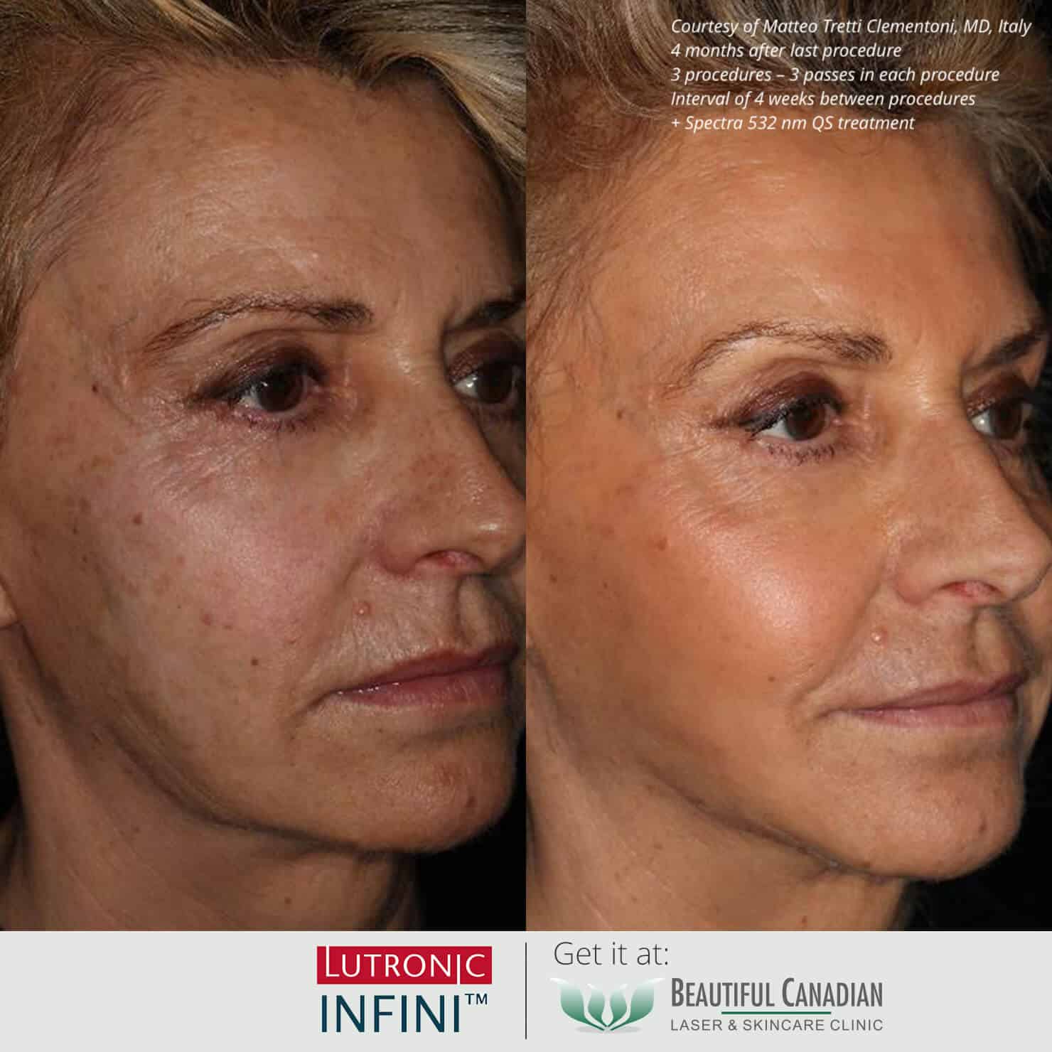 Before and after images of Infini RF hot microneedling procedure for wrinkles and skin texture - available in Vancouver