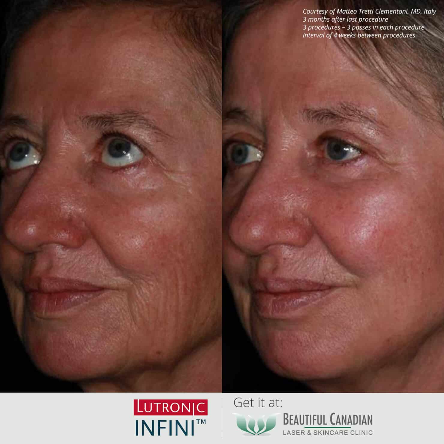 Before and after images of Infini RF hot microneedling procedure for skin laxity - available in Vancouver