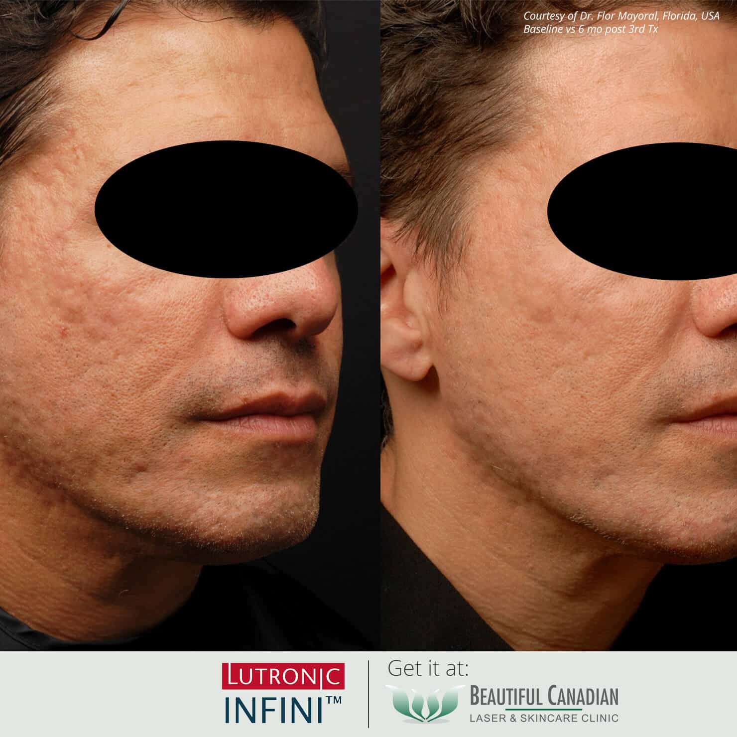 Before and after images of Infini RF hot microneedling procedure for acne scars - available in Vancouver