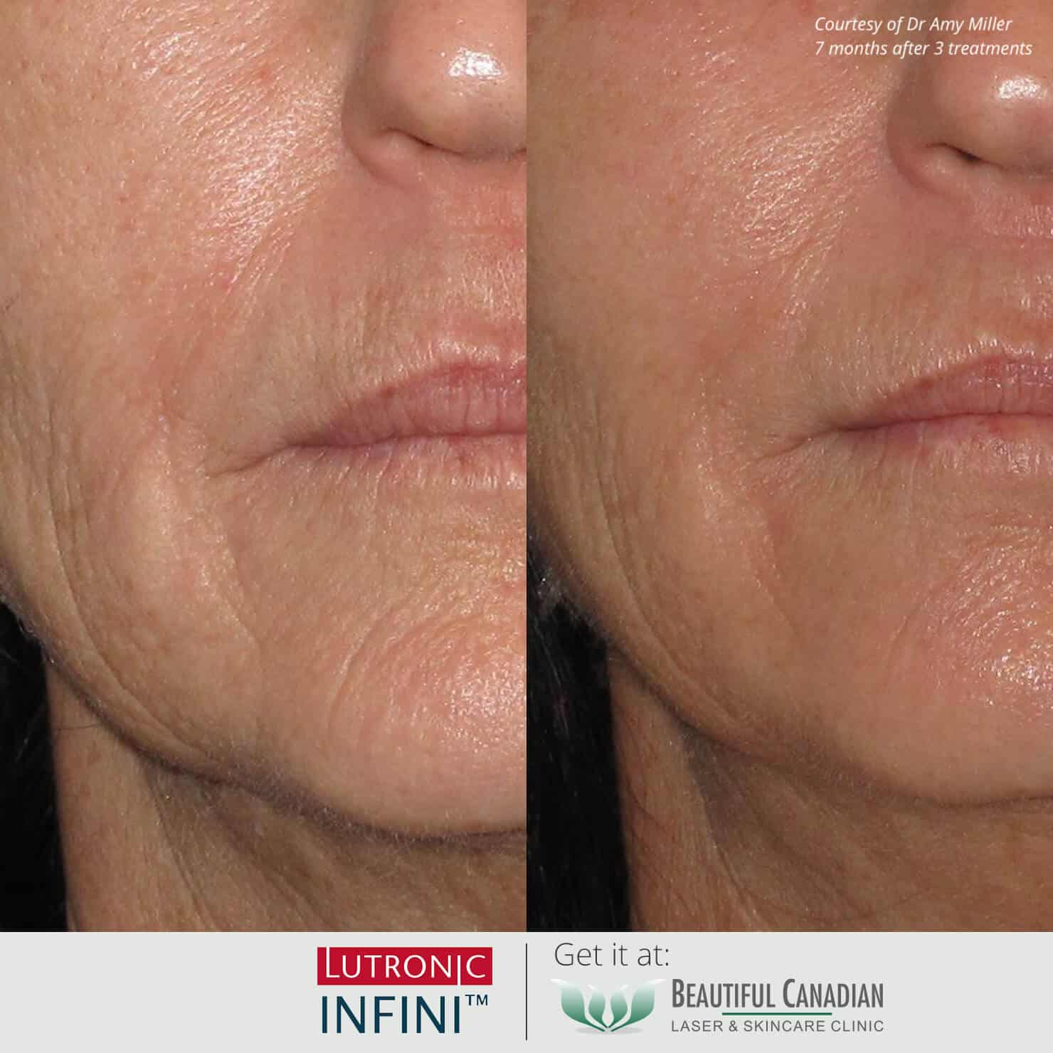 Before and after images of Infini RF hot microneedling procedure for wrinkles anti-aging treatment - available in Vancouver