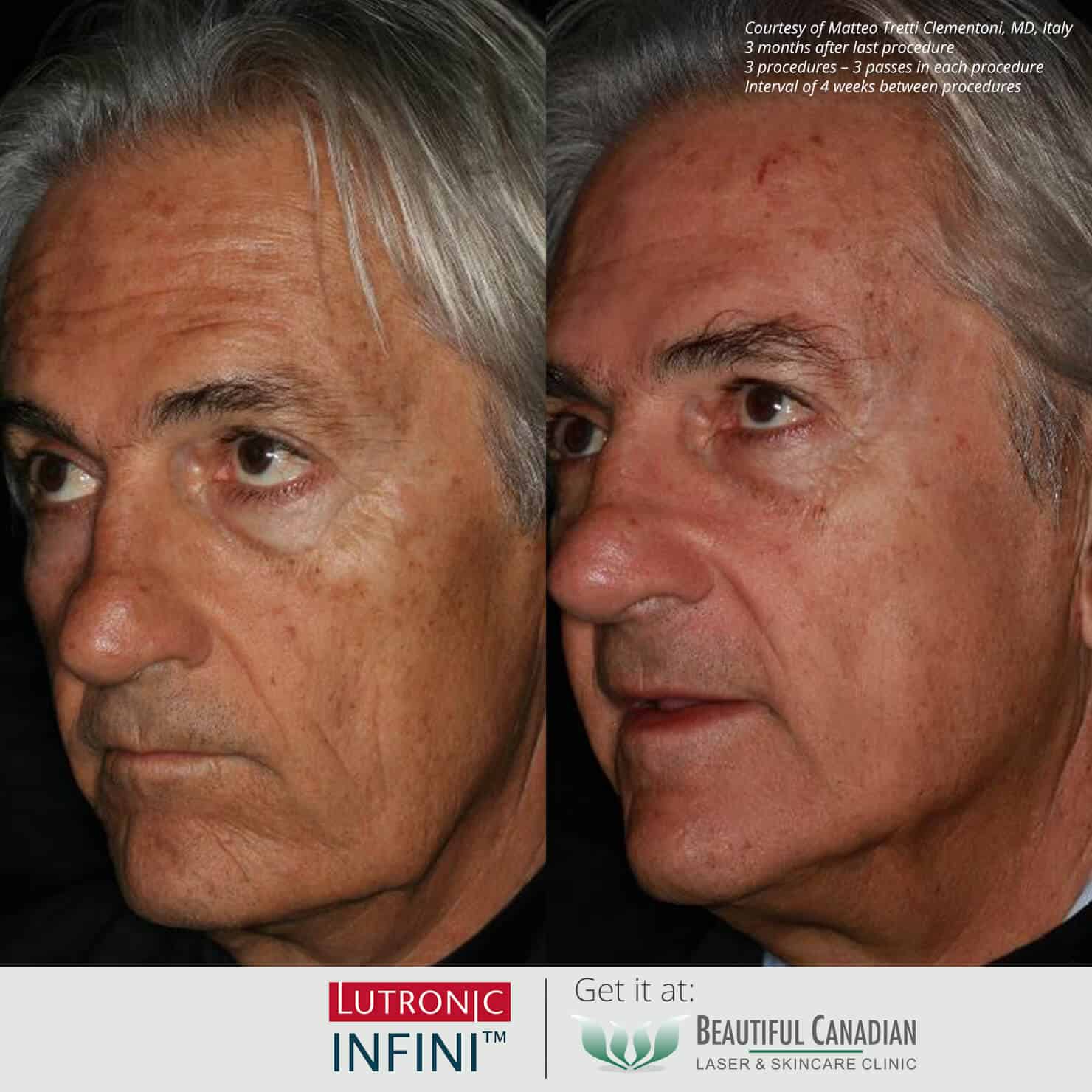 Before and after images of Infini RF hot microneedling procedure for skin laxity - available in Vancouver