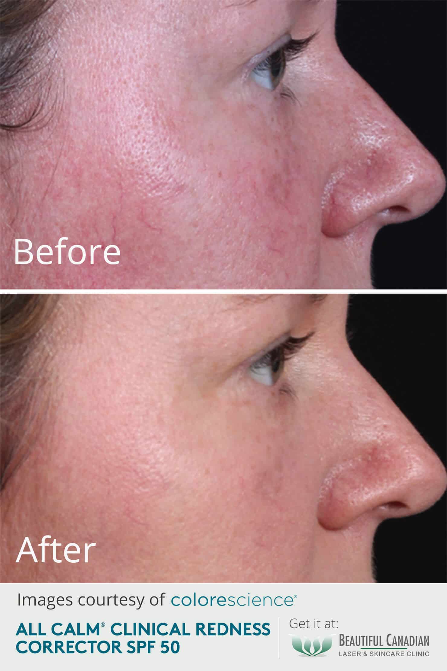 Colorescience All Calm Clinical Redness Corrector with SPF - Redness Face Cream - Before and After Results - set 1