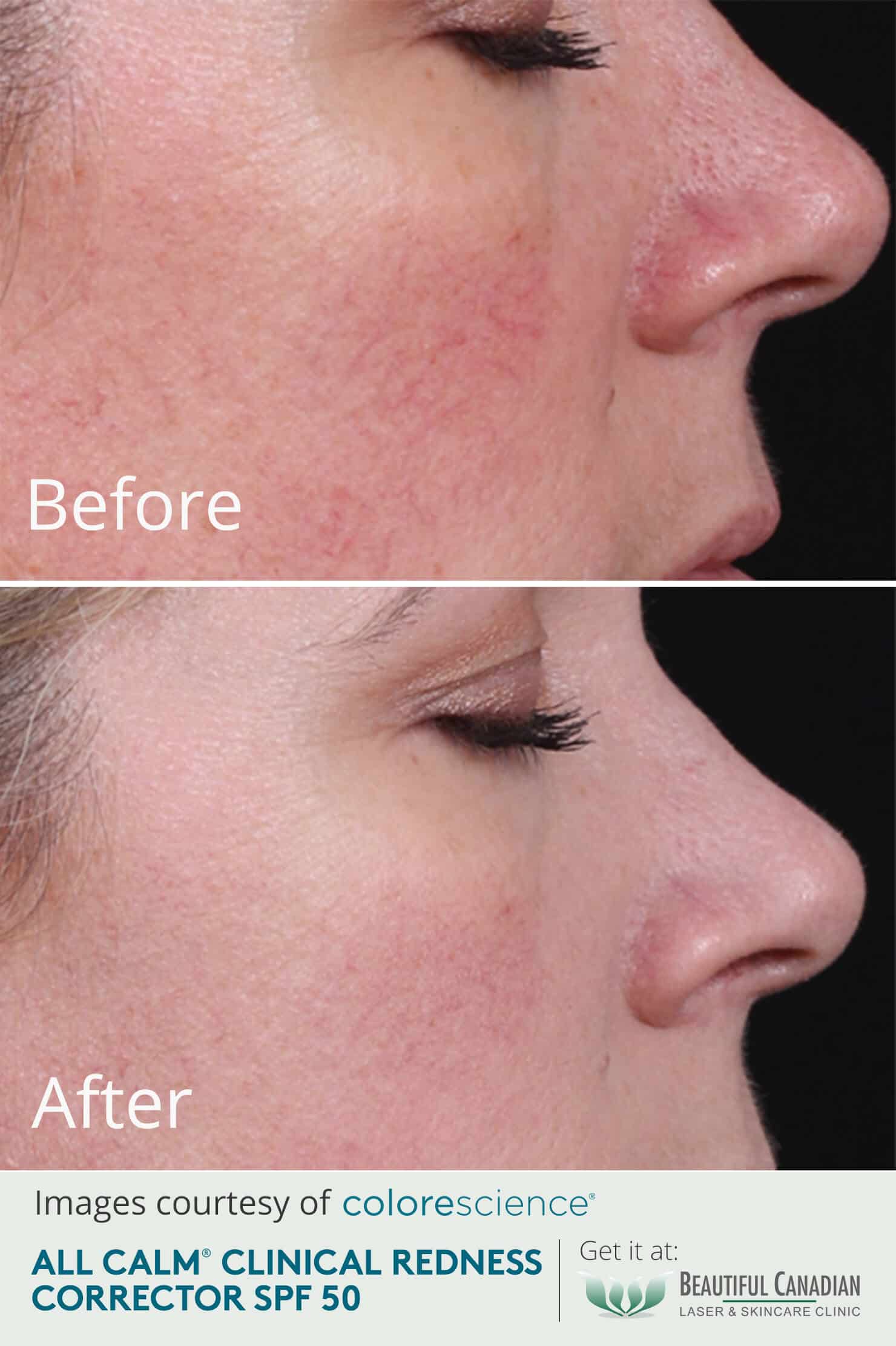Colorescience All Calm Clinical Redness Corrector with SPF - Redness Face Cream - Before and After Results - set 2