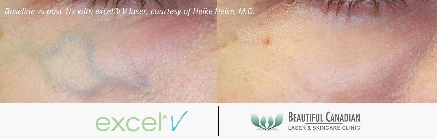 periorbital vein removal before and after with excel V vascular laser - available in Surrey Vancouver