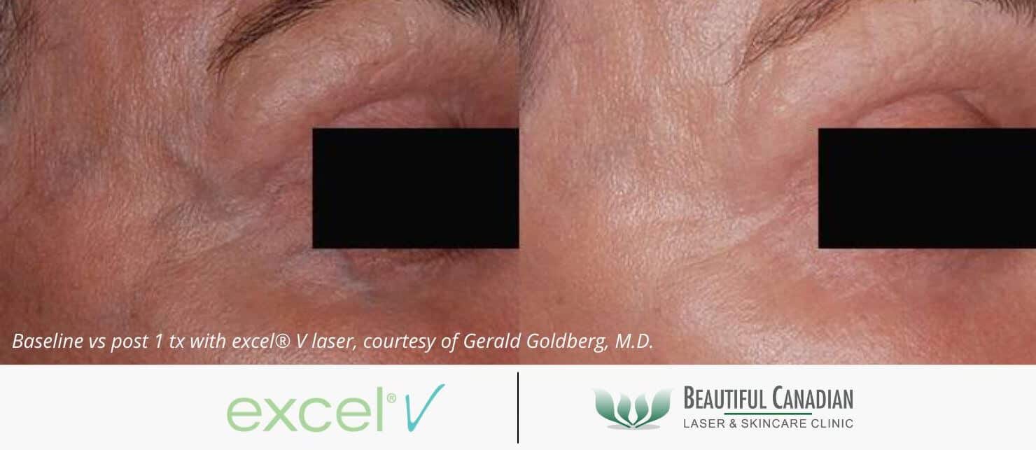 periorbital vein treatment before and after with excel V vascular laser - available in Surrey Vancouver