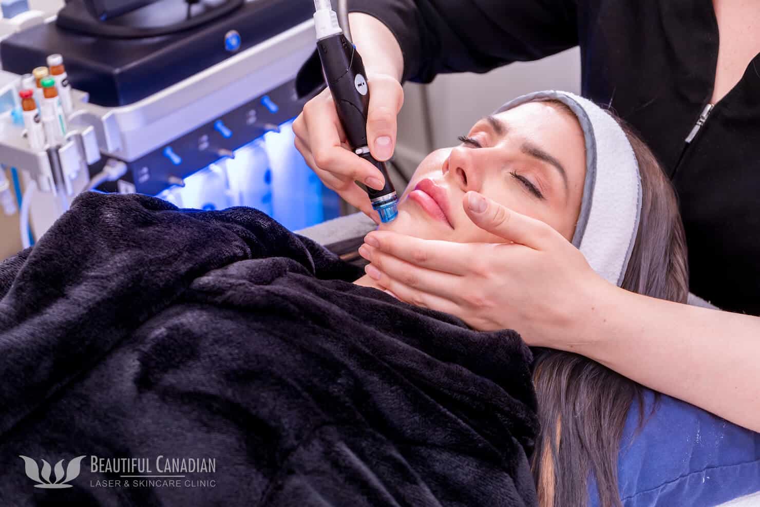 Hydrafacial session with famale patient and wand at a medspa in Surrey