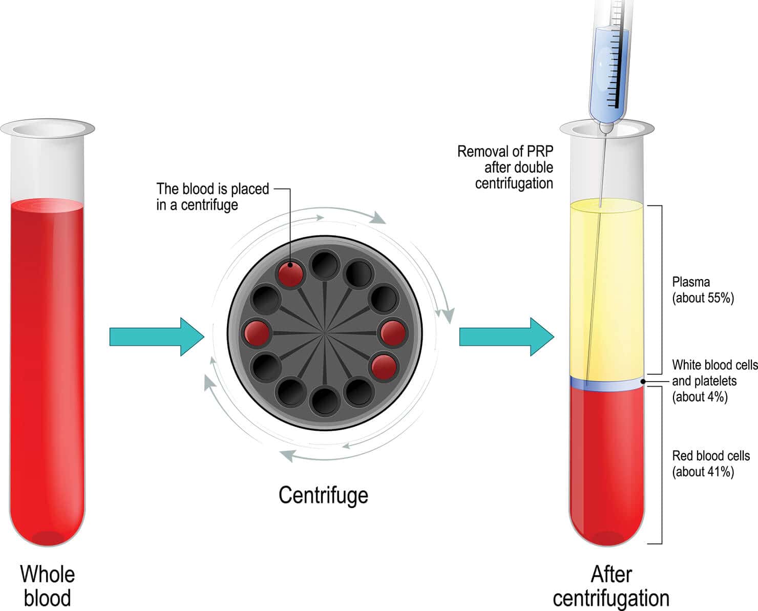 Illustration of PRP centrifugation and effect on blood platelet extraction