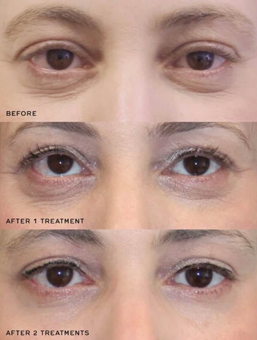 PRP vampire facial for dark under eye circles wrinkles - before and after treatment photos