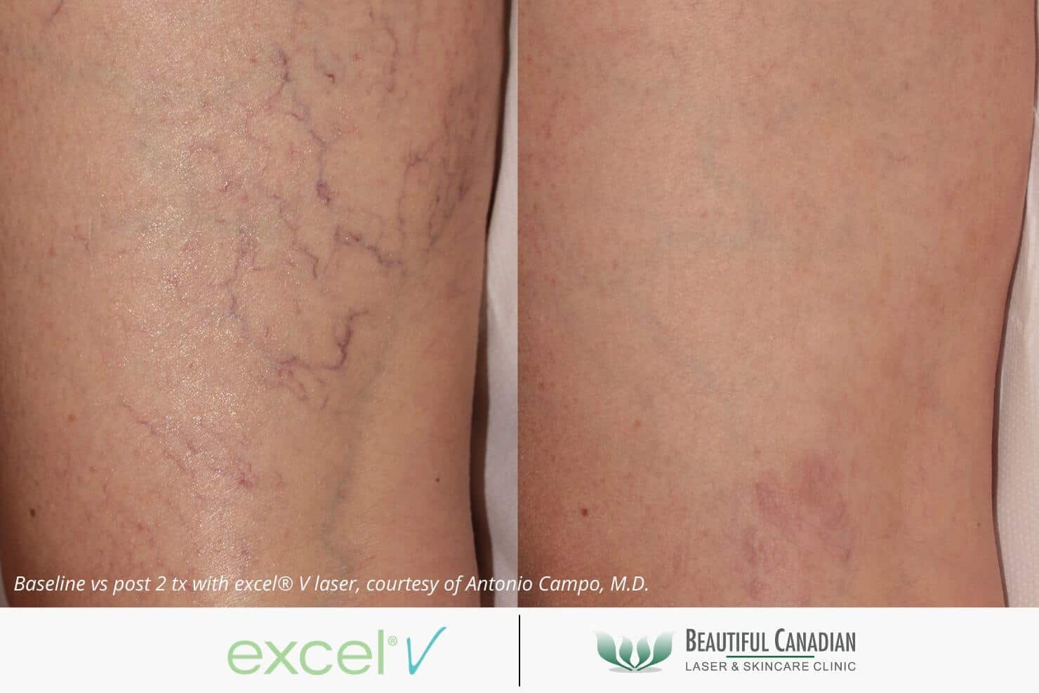 leg spider vein treatment before and after with excel V vascular laser - available in Vancouver Surrey