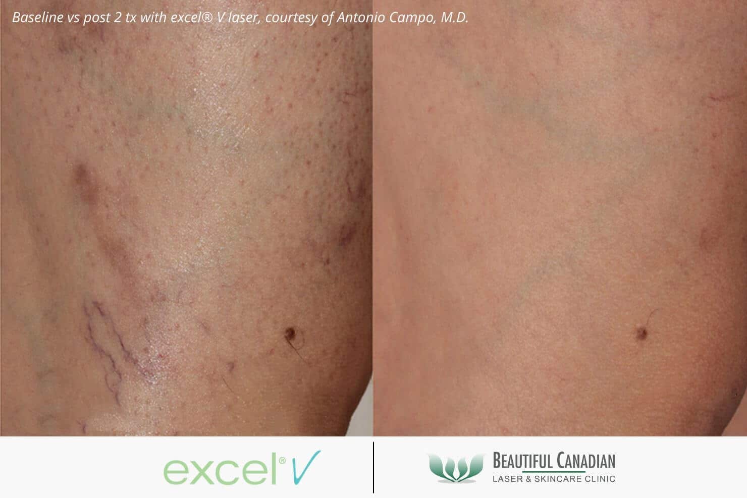 leg spider vein bruising treatment before and after with excel V vascular laser - available in Vancouver Surrey