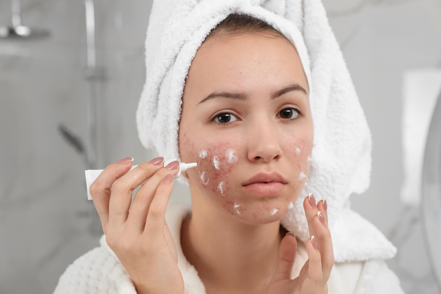 Teen with acne and redness using skin care on face