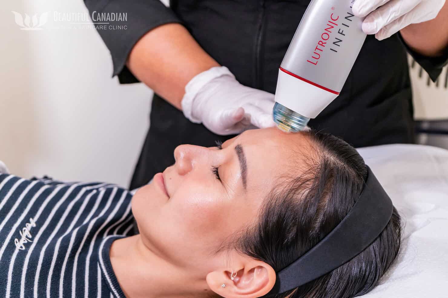 Vancouver RF microneedling treatment in Surrey on female - skin rejuvenation with Infini RF