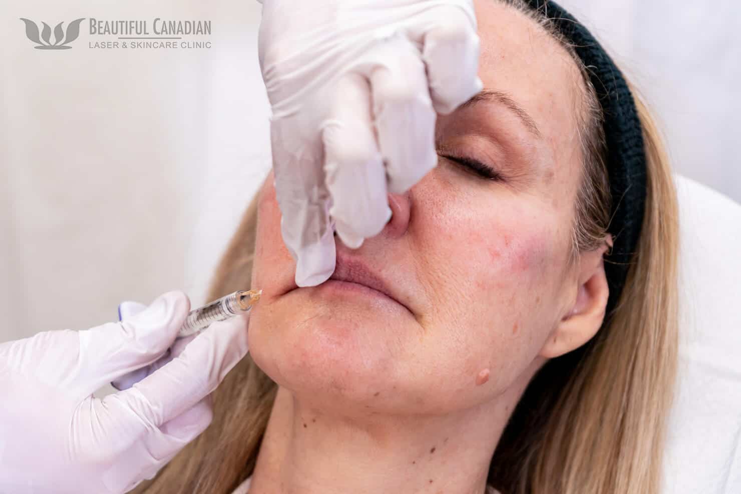 Vancouver lip filler procedure with doctor - cannula injection - in Surrey