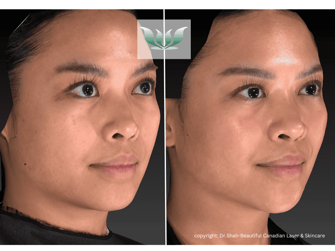 Dr. Shah before and after - BC Laser & Skincare Clinic