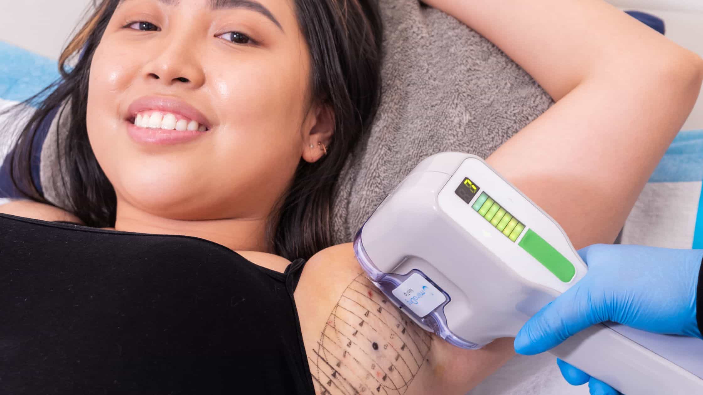 Young woman having the miraDry treatment performed on her at BC Laser and Skincare Clinic in Surrey, BC.