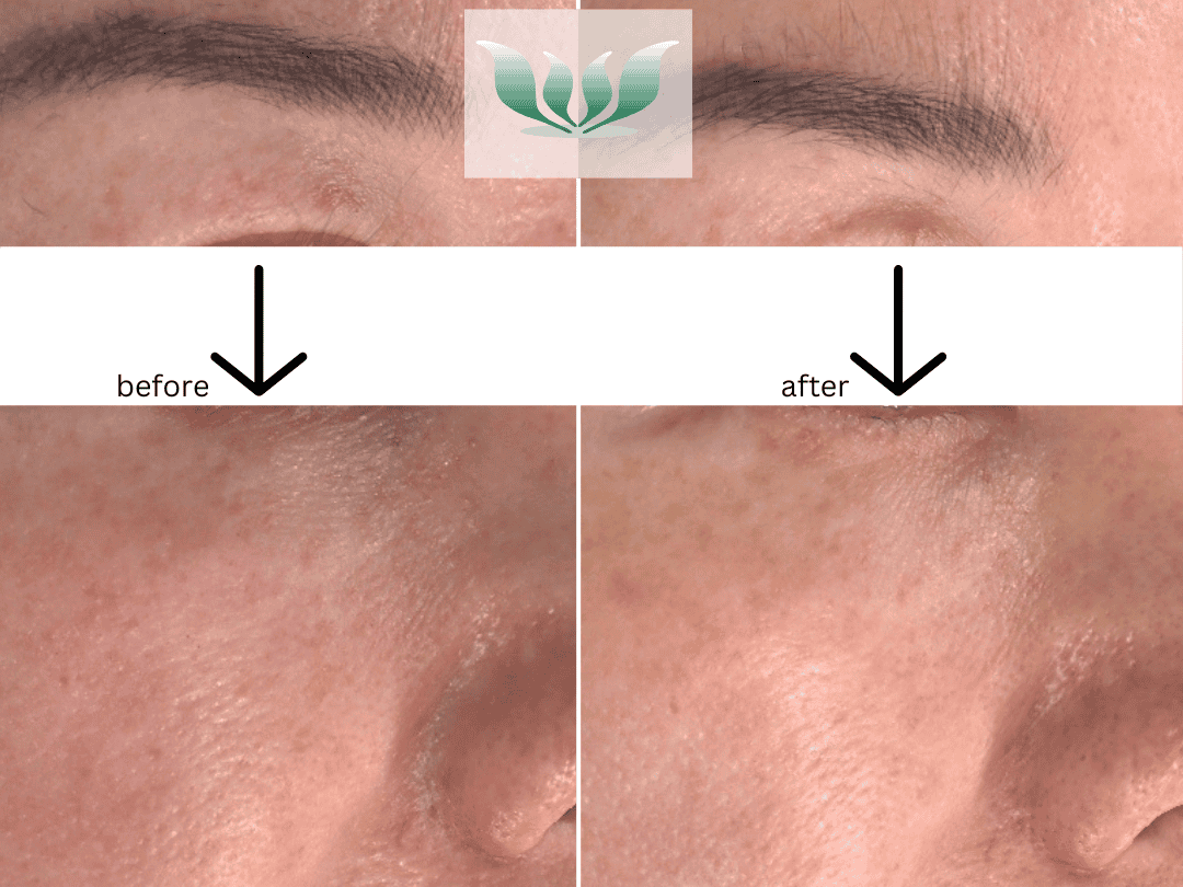 Dr. Shah before and after - BC Laser & Skincare Clinic