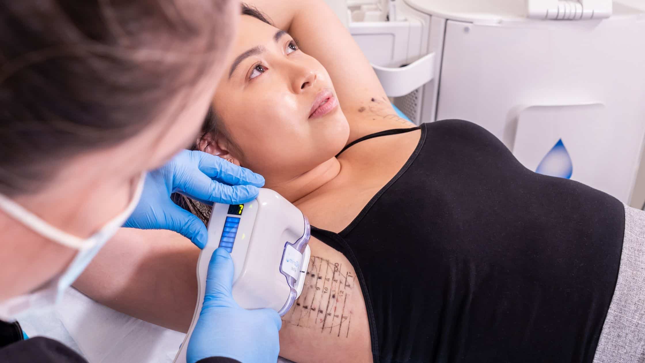 Young woman having the miraDry treatment performed on her at BC Laser and Skincare Clinic in Surrey, BC.