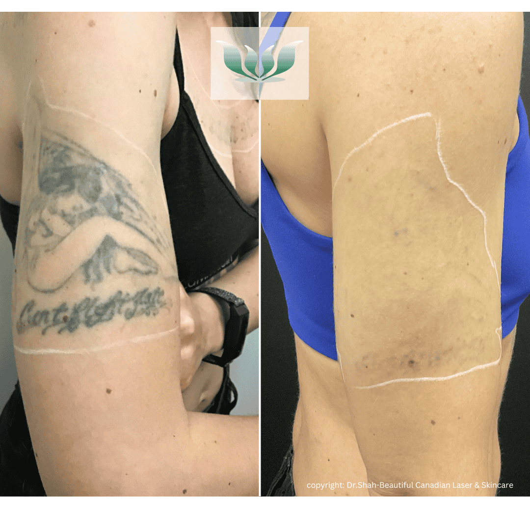 Tattoo Removal before and after - BC Laser & Skincare Clinic