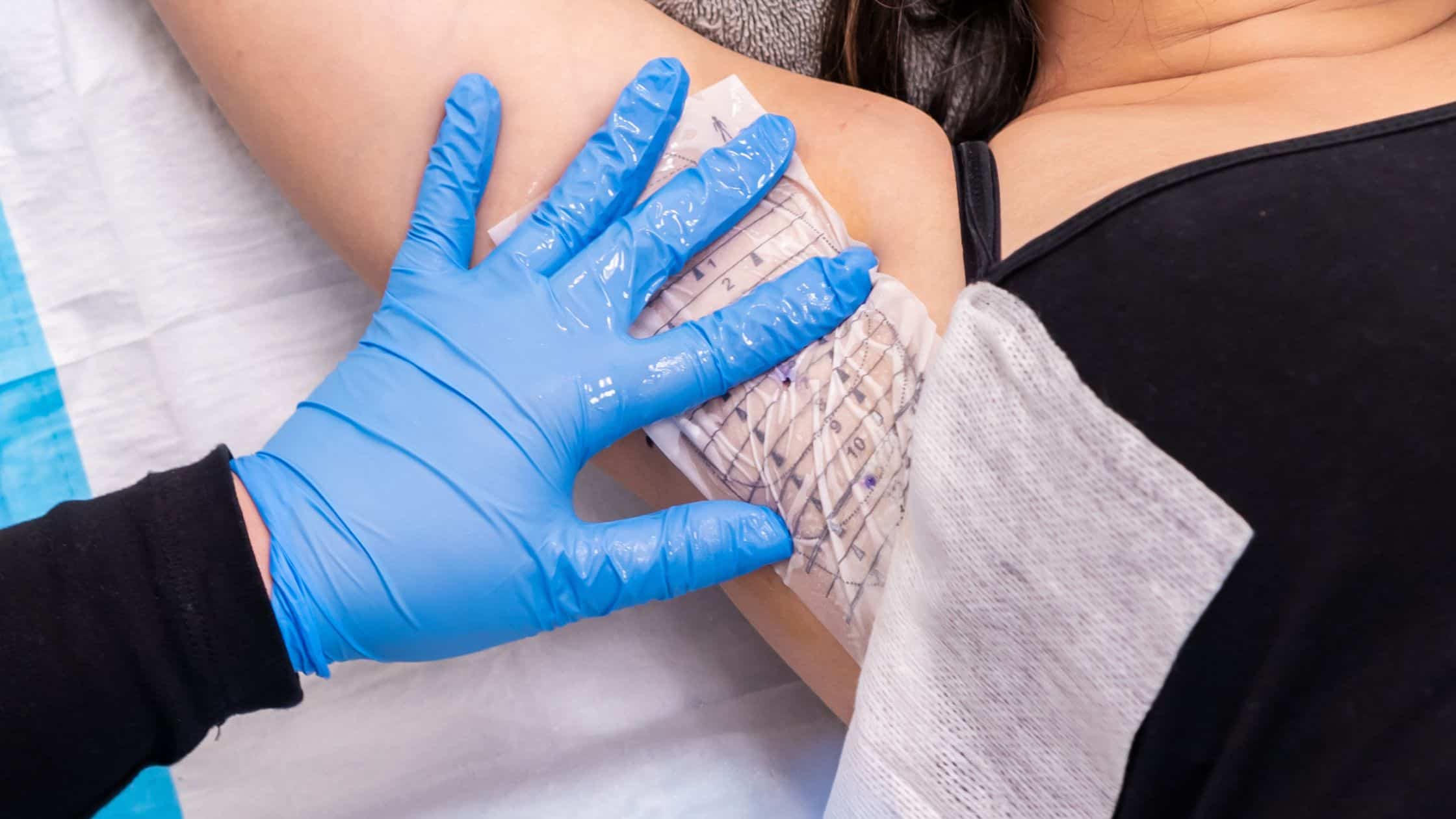 Close-up if miraDry tattoo on a young woman's armpit at BC Laser and Skincare in Surrey, BC.