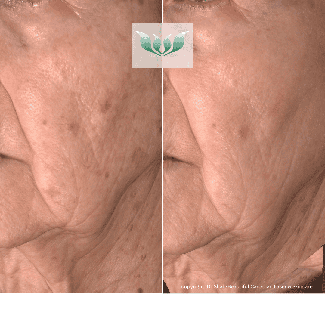 Dr. Shah before and after - BC Laser & Skincare Clinic