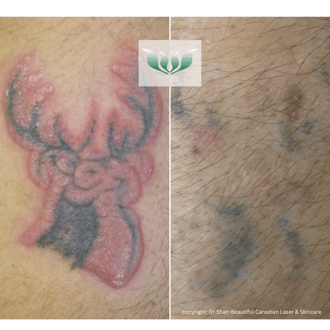 Tattoo Removal before and after - BC Laser & Skincare Clinic