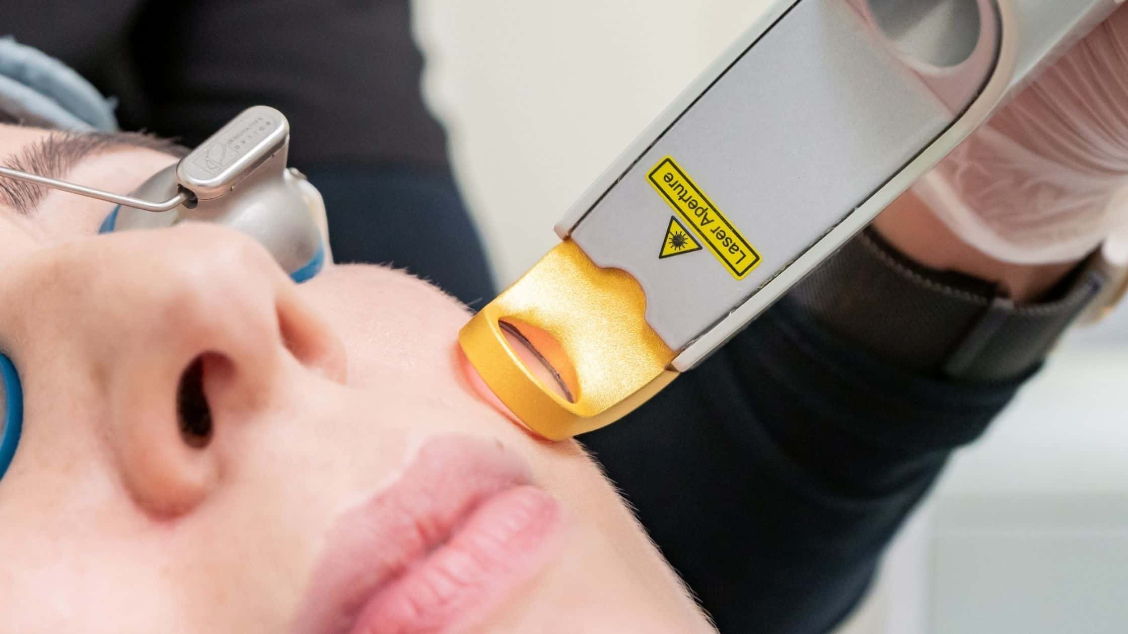 Excel V laser treatment at Beautiful Canadian Laser and Skincare Clinic in Surrey, BC