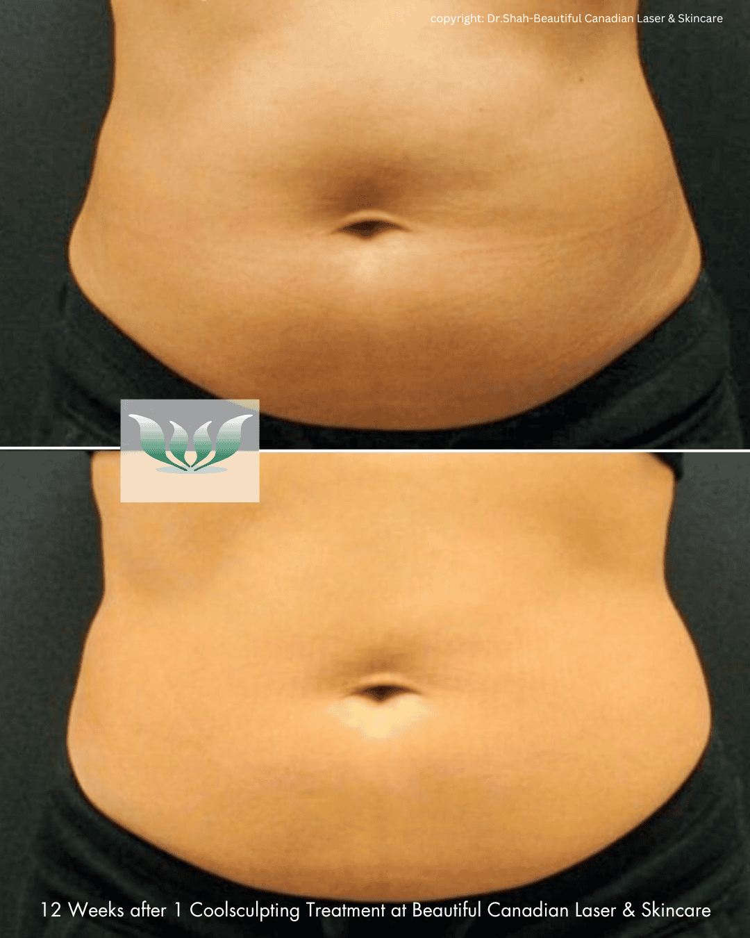 Coolsculpting Abdomen before and after - BC Laser & Skincare Clinic