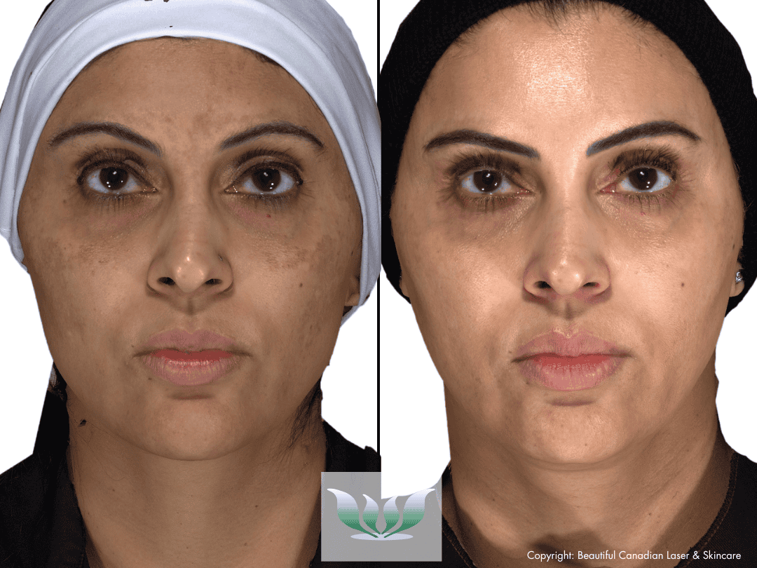 SkinMedica Product Melasma before and after - BC Laser & Skincare Clinic