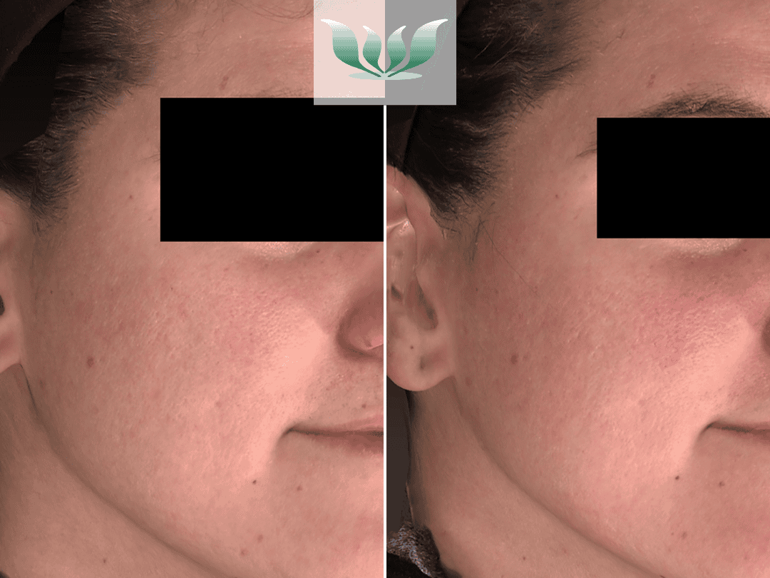 Dr. Shah before and after - BC Laser & Skincare Clinic