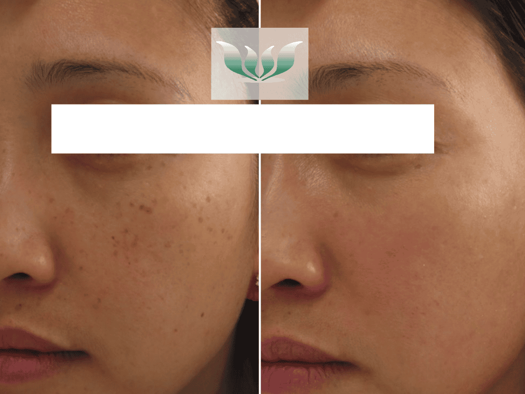 Dr. Shah before and after - BC Laser & Skincare Clinic